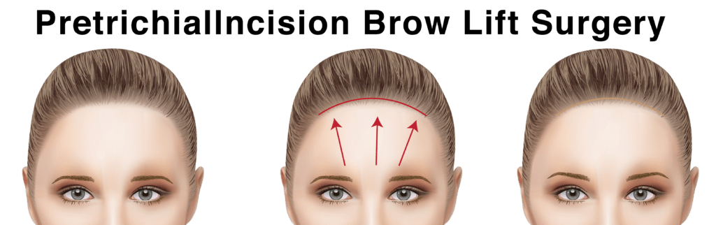 การศัลยกรรมยกคิ้วด้วยเทคนิค Pretrichial Incision Brow Lift