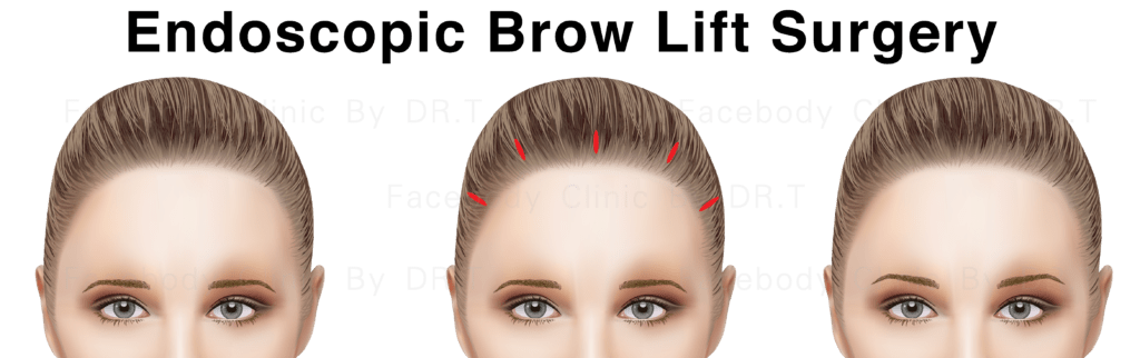 การยกคิ้วด้วยเทคนิค ผ่าตัดผ่านกล้อง Endoscopic Brow Lift