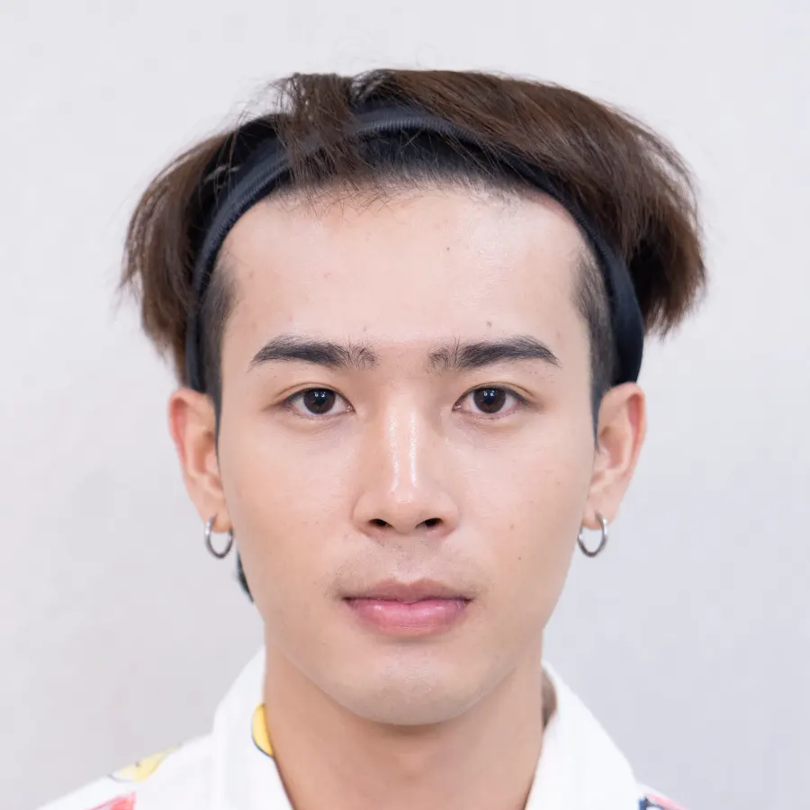 Review-BF-Hair-transplantation-DHI-FUE-Facebody Clinic