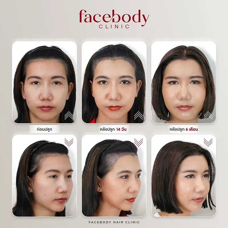 ปลูกผมผู้หญิง ตอบชัดๆ ผู้หญิงปลูกผมได้ไหม