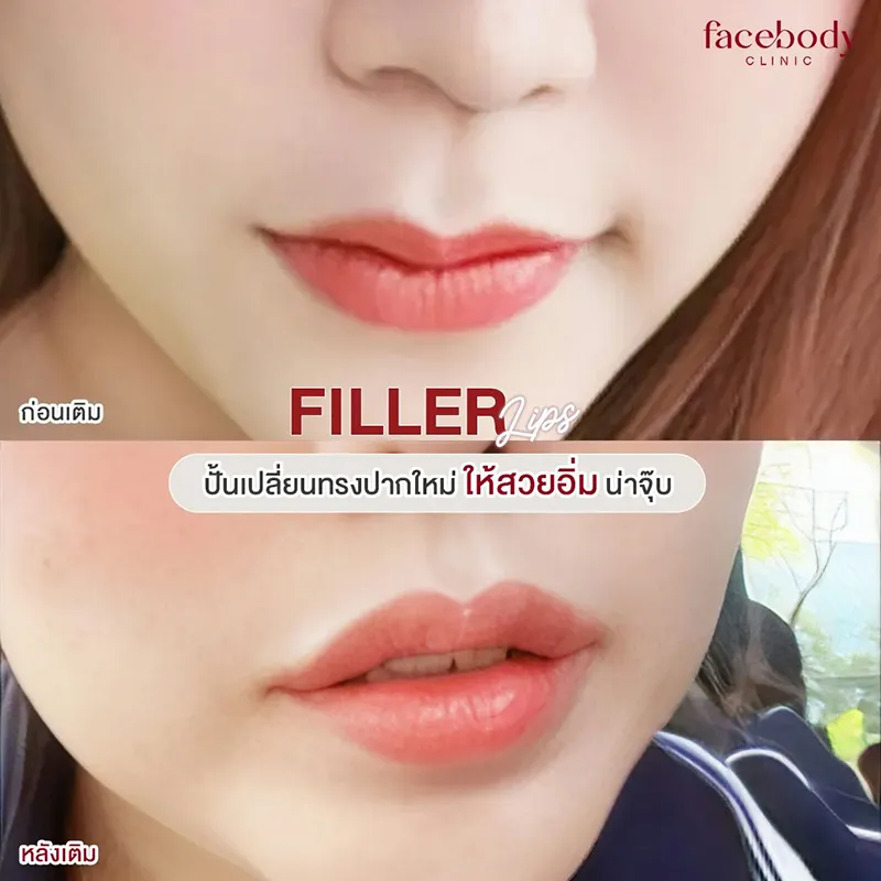 ฟิลเลอร์ปาก