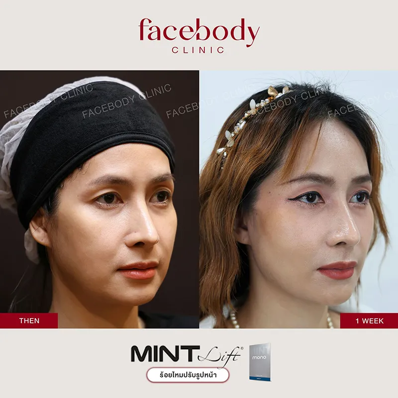ร้อยไหม ยกกระชับทันใจ เห็นผลทันที