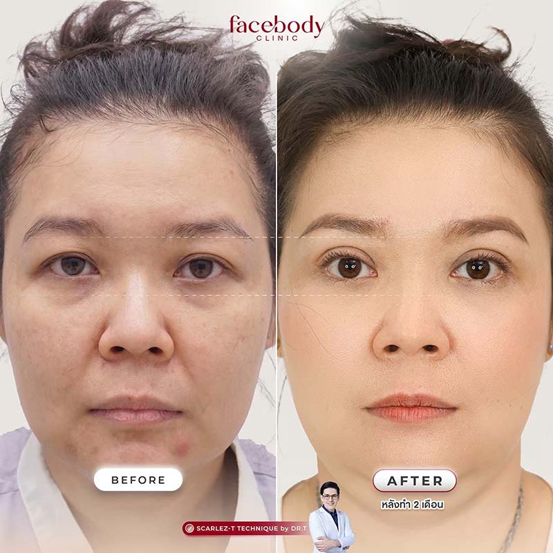 ทำตาสองชั้น คนสูงอายุ