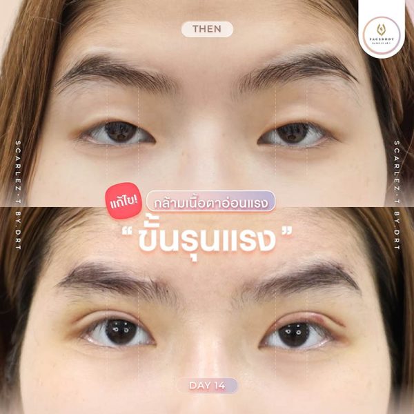 ทำตาสองชั้นราคา ทำตาสองชั้นราคา