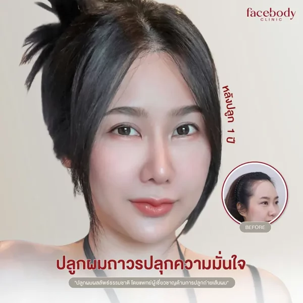 ผู้หญิง-(ปลูกผม คิ้ว) ปลูกผมผู้หญิง ตอบชัดๆ ผู้หญิงปลูกผมได้ไหม