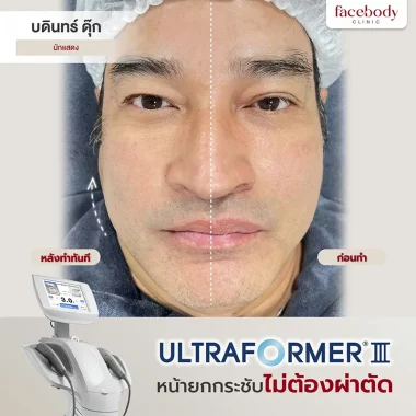 ULTRAFORMER III (5)