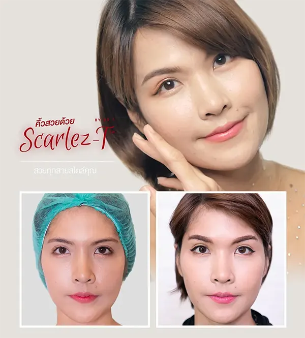 ยกคิ้ว ศัลยกรรม แก้ปัญหา คิ้วตก ตาตก​