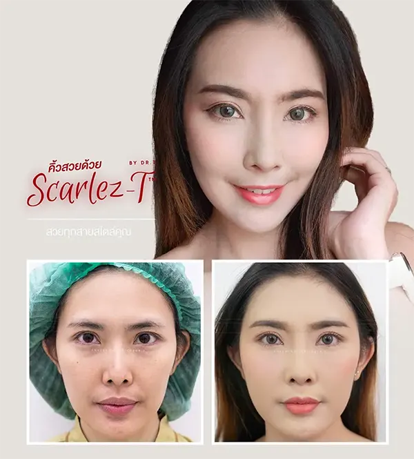 ยกคิ้ว ศัลยกรรม แก้ปัญหา คิ้วตก ตาตก​