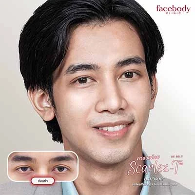 ทำตาสองชั้น ปลูกผม ยกคิ้ว ฟิลเลอร์