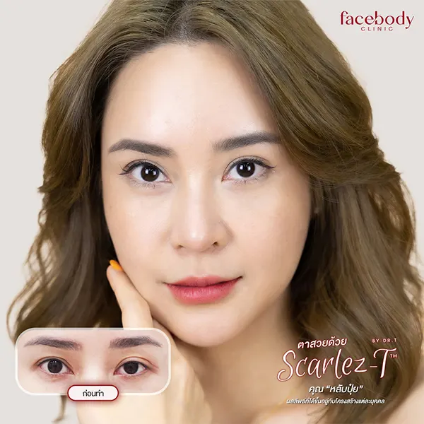 ทำตาสองชั้น ปลูกผม ยกคิ้ว ฟิลเลอร์