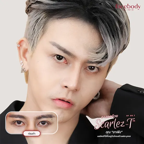 ทำตาสองชั้น ปลูกผม ยกคิ้ว ฟิลเลอร์