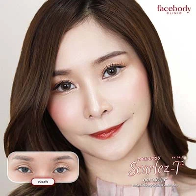 ทำตาสองชั้น ปลูกผม ยกคิ้ว ฟิลเลอร์