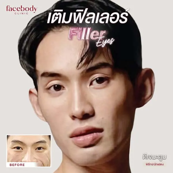 ทำตาสองชั้น ปลูกผม ยกคิ้ว ฟิลเลอร์